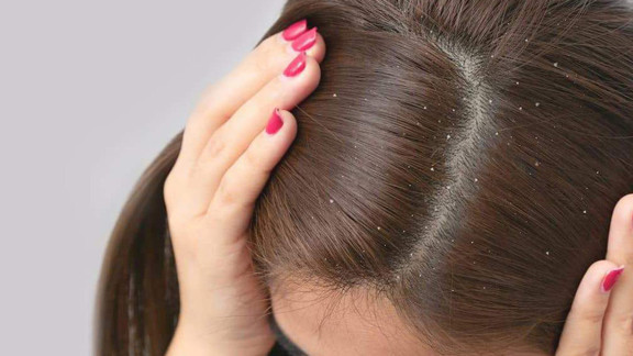 Saçtaki kepek nasıl geçer? Saçtaki kepekten kurtulmak için evde uygulanabilecek yöntemler