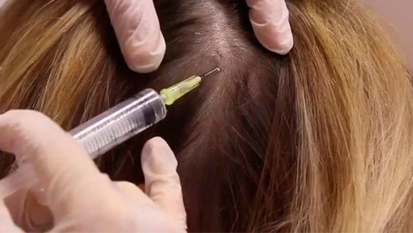 Mezoterapi Saç İçin Nasıl Yapılır Saç Mezoterapisi Yaptıranlar Memnunmu