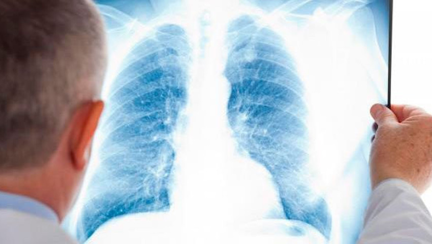 Akciğerde Leke Nedir Ne Anlama Gelir Neden Olur Nasıl Geçer?
