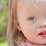 Hamilelikte Down Sendromlu Bebek Nasıl Anlaşılır? Ultrason Belirtileri
