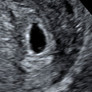 Gebelikte Bebek Ultrason Terimleri Ne Anlama Gelir