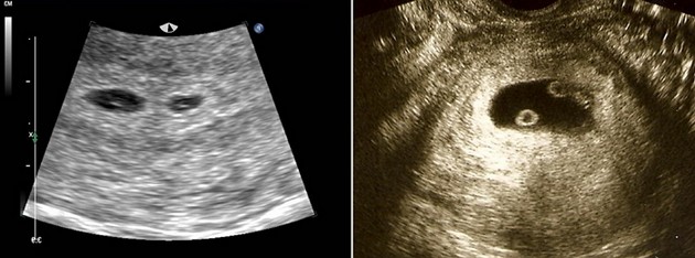 3 haftalik gebelik belirtileri gelisimi ve ultrason goruntuleri