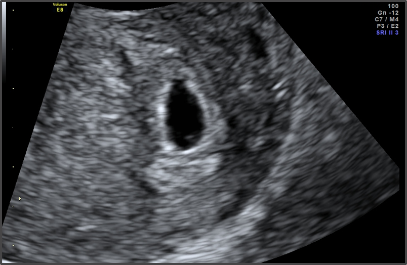 toksik alayci kus baskin 6 haftalik bebek ultrasonda gorunurmu sudecicekcilik net