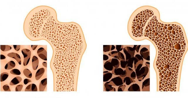 Kemik Erimesi (Osteoporoz) Nedir Öldürürmü Kemik Erimesi İlaçları Neler?