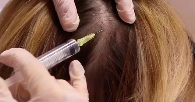 Mezoterapi Saç İçin Nasıl Yapılır Saç Mezoterapisi Yaptıranlar Memnunmu