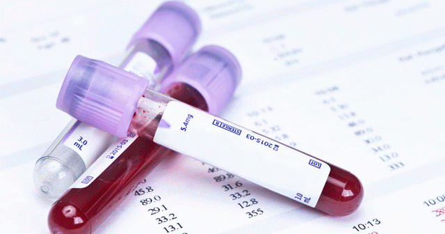 4lü Tarama Testi Riskli Çıkanlar Ne Yapmalı Dörtlü Tarama Testi Yaptıranlar