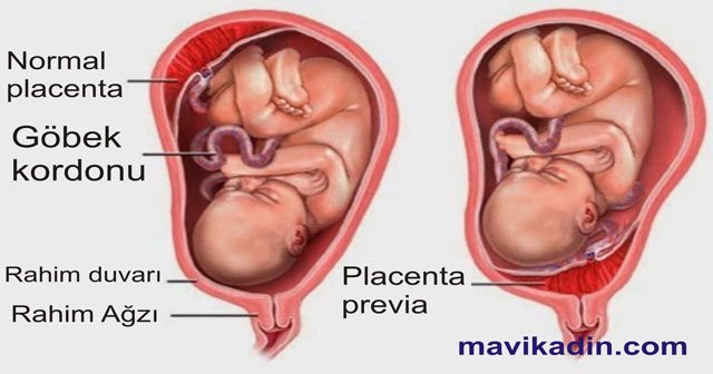 Plasenta Previa Totalis Marginalis Marjinal Nedir Doğum Yapanlar Var mı