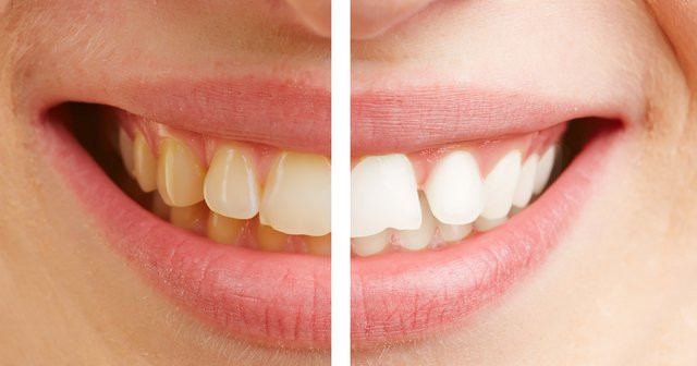 Zeytinyağı Dişleri Beyazlatır mı? Zeytinyağıyla Diş Parlatma