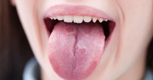 dilde mantar dil mantari neden olur nasil gecer bitkisel tedavi
