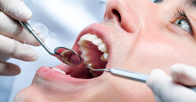 Diş Neden Kırılır Diş Kırılması Neden Olur Tedavisi Dişim Kırıldı