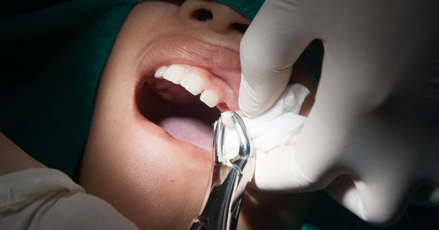 Diş Çekimi Sonrası Kanama Çekilmiş Diş Kanaması Nasıl Durur?
