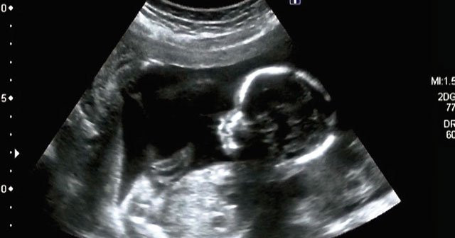 15 haftalik gebelikte bebek karnin neresinde yer alir