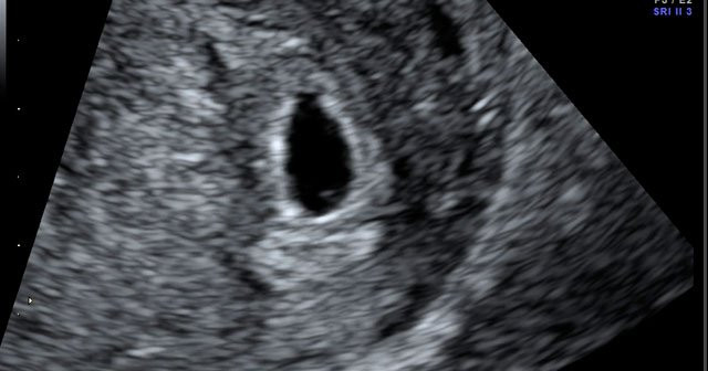Gebelikte Bebek Ultrason Terimleri Ne Anlama Gelir