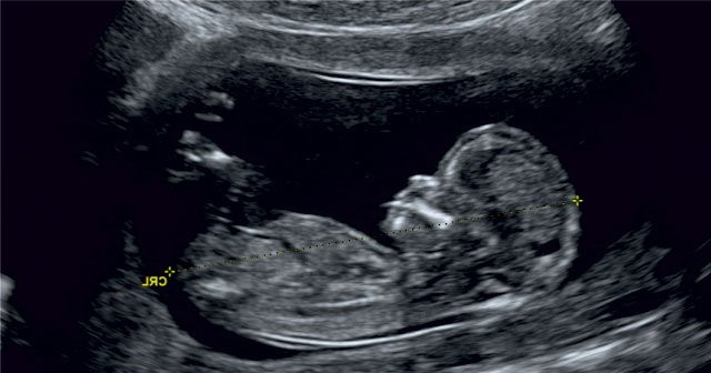 6 haftalik bebek kac mm olur ultrason goruntusu ve annedeki degisiklikler