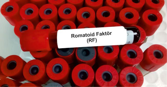 RF (Romatoid Faktör) nedir? RF yüksekliği ve düşüklüğü neden olur? Nasıl tedavi edilir?