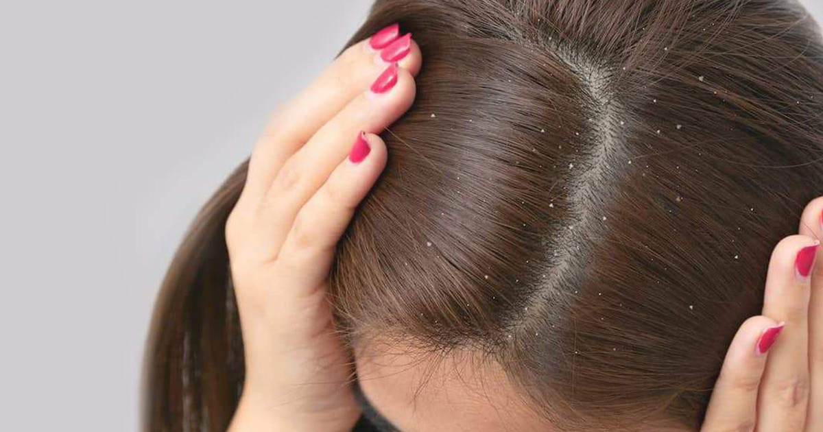 Saçtaki kepek nasıl geçer? Saçtaki kepekten kurtulmak için evde uygulanabilecek yöntemler