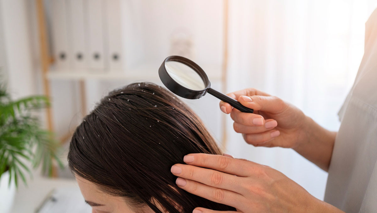 Karbonatın onlarca faydasından biri de saç derisindeki kepeği yok etmekte etkili olması.